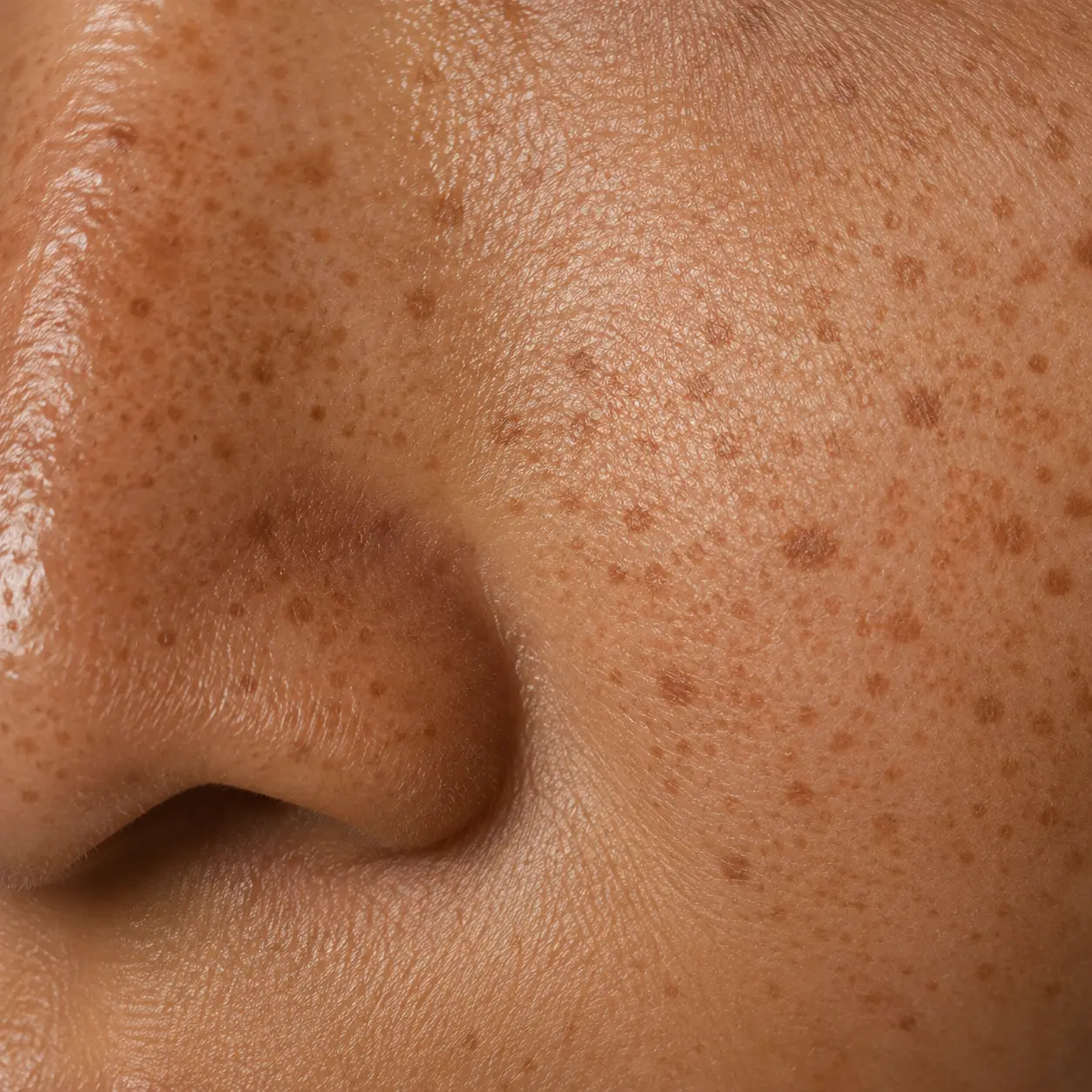 Close-up of freckles and small, well-defined sun spots (lentigines) built up from years of sun exposure