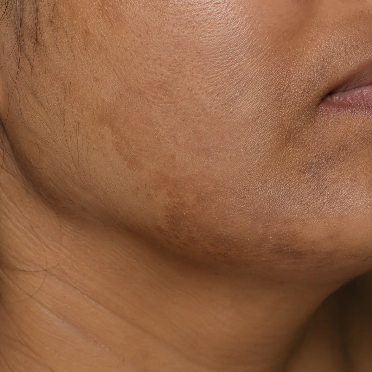 Close-up of hormonal pigmentation along the jawline, a pattern linked to pregnancy, contraceptives, or thyroid changes