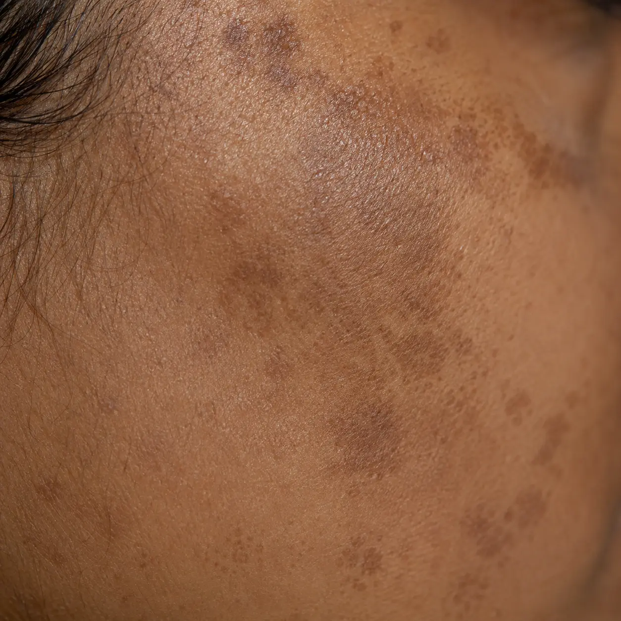 Close-up of melasma — symmetrical brown-grey pigmentation patches across the cheeks and forehead