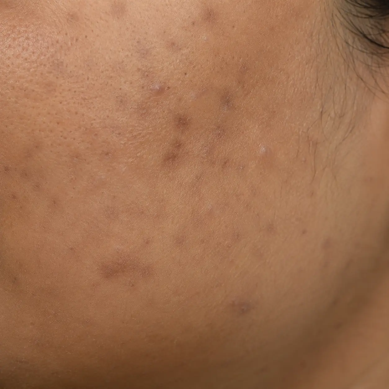 Close-up of post-inflammatory dark marks left behind after acne has healed